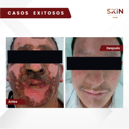 quemaduras-skinmedical-antes-despues-18-03-2024