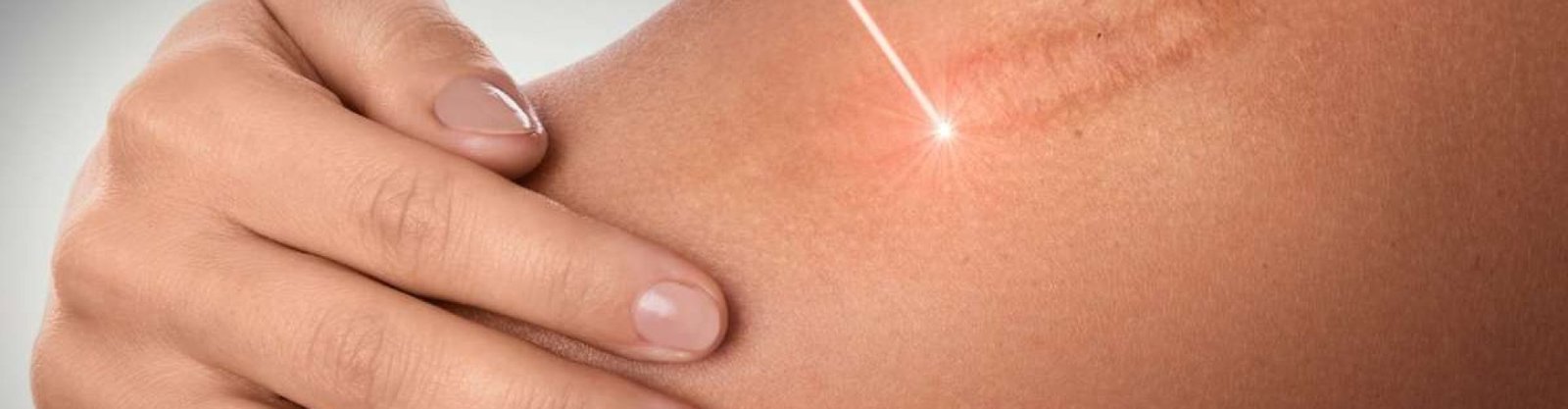 quitar-cicatriz-queloide quitar-cicatriz-queloide