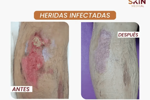 tratamiento de heridas