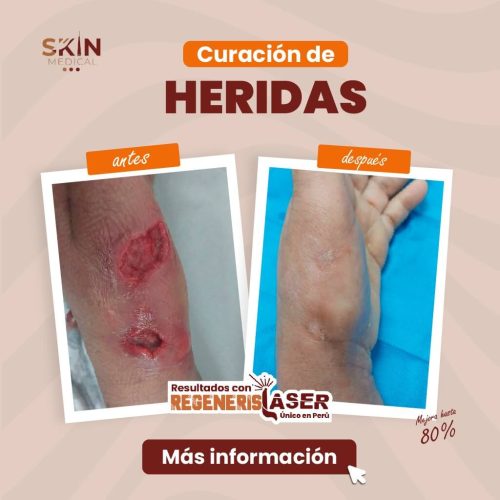 tratamiento de heridas