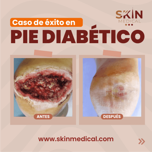 tratamiento de pie diabetico