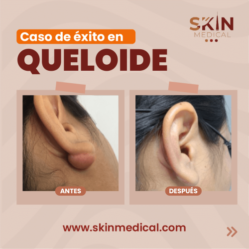 tratamiento de queloides