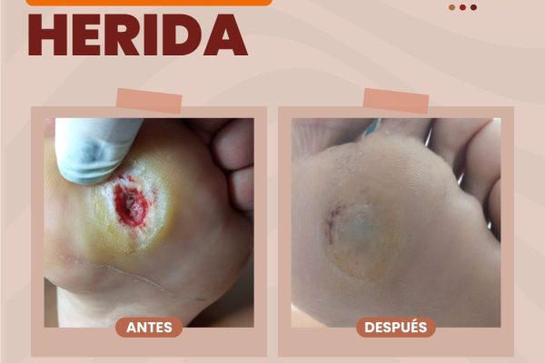 tratamiento de heridas