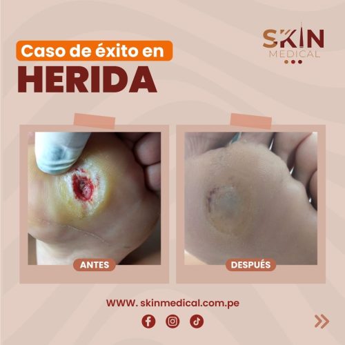 tratamiento de heridas