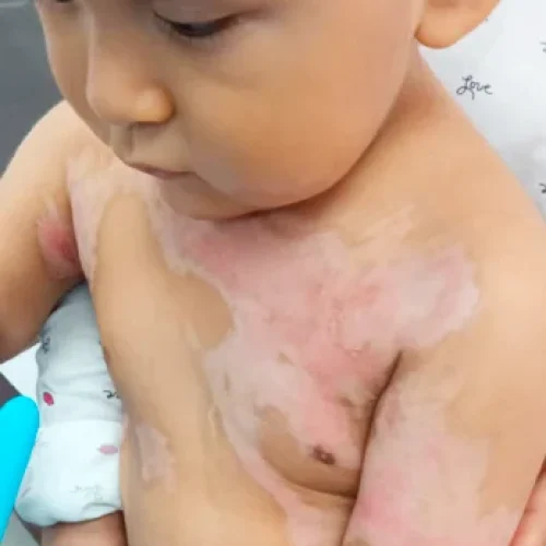 tratamiento de quemaduras Graves 2