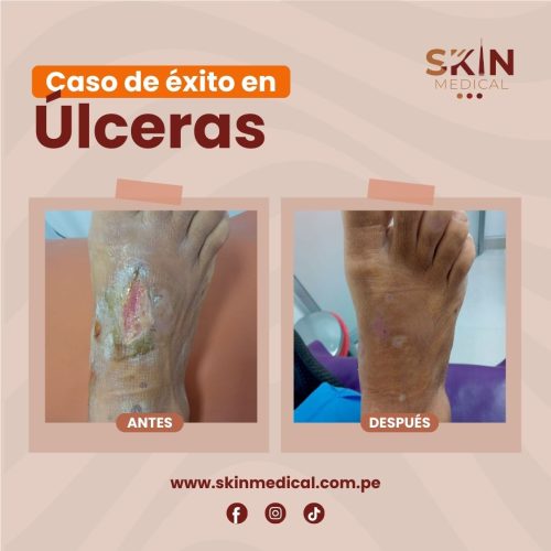 ulceras: antes y despues