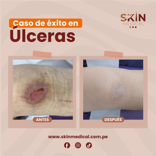 ulceras: antes y despues